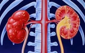 Qabziyat va buyrak yetishmovchiligi o'rtasidagi munosabatlar